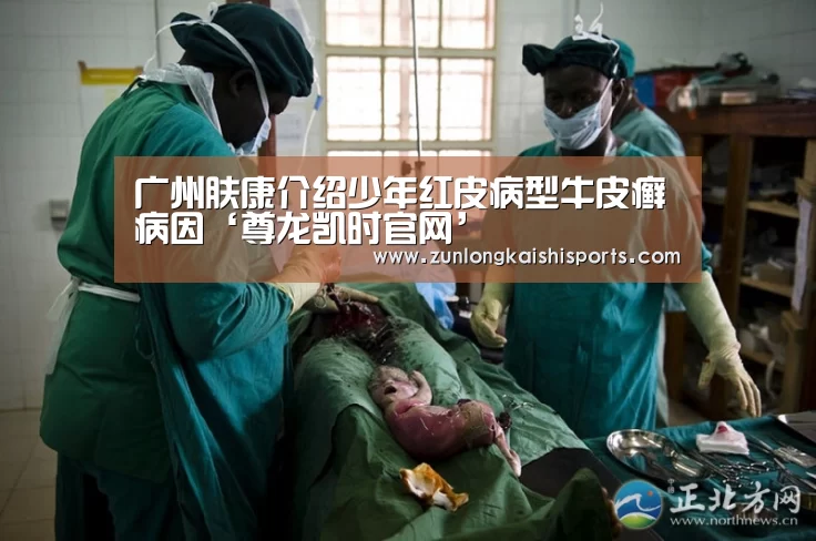 广州肤康介绍少年红皮病型牛皮癣病因‘尊龙凯时官网’(图2) 尊龙凯时